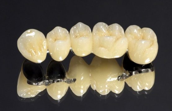 Răng sứ Coban-Crom – Giải pháp phục hình hiệu quả, đẹp, tiết kiệm