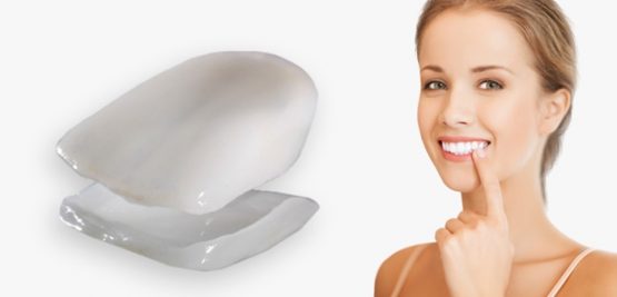 Làm răng sứ Laminate có tốt không? Tổng hợp thông tin bạn cần biết