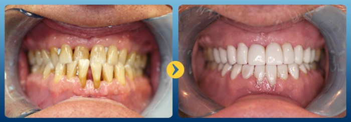 Bọc răng sứ có hết móm không, hay phải điều trị cách nào hiệu quả? 1
