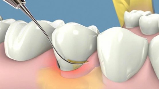 Cao răng, vôi răng là gì, 6 cách để ngừa cao răng