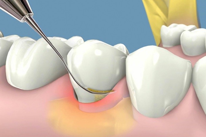 Cạo vôi răng và tẩy trắng răng cùng lúc có được không?