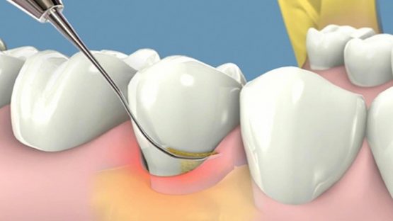 Tác hại của cao răng (vôi răng) và biện pháp ngăn ngừa