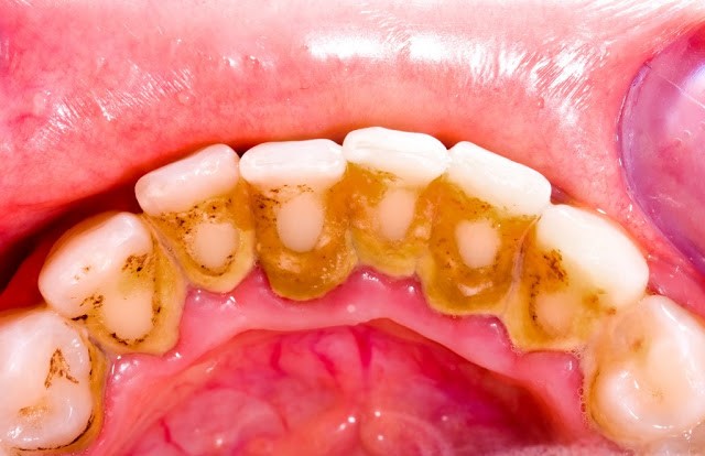 Cạo vôi răng và tẩy trắng răng cùng lúc có được không?