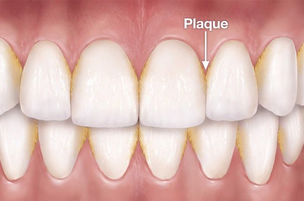 Cạo Vôi Răng Có Trắng Răng Không? Bí Quyết Giúp Răng Sáng Bóng Hiệu Quả