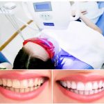 Nên tẩy trắng răng tại nhà hay phòng khám nha khoa? Nên tẩy trắng răng tại nhà hay phòng khám nha khoa?