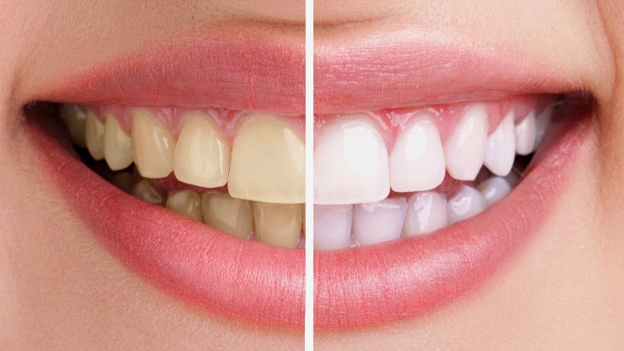 Tẩy trắng răng Hàn Quốc đem lại cho bạn nụ cười trắng sáng, tự tin