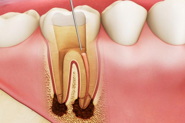 Lấy tủy răng số 7 có đau không?