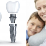 Những thông tin cần biết về trồng răng implant vĩnh viễn Những thông tin cần biết về trồng răng implant vĩnh viễn