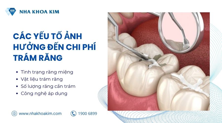 yếu tố ảnh hưởng đến giá trám răng bao nhiêu tiền