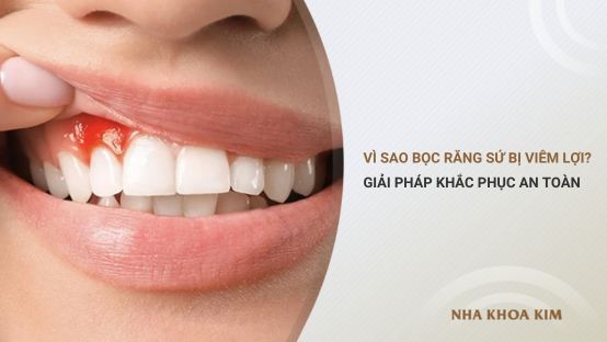 Vì sao bọc răng sứ bị viêm lợi? Giải pháp khắc phục an toàn
