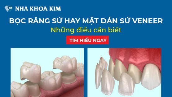 Chi phí dán sứ Veneer bao nhiêu tiền một răng? Bảng giá mới nhất 2025