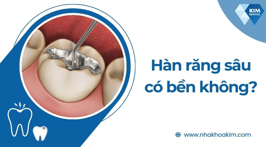 Hàn răng sâu có bền không?