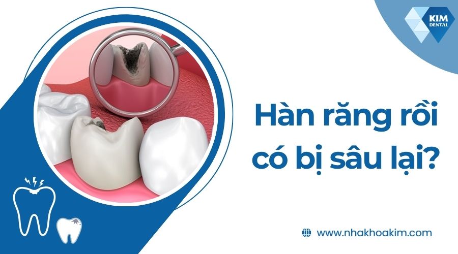 Hàn răng rồi có bị sâu lại không?