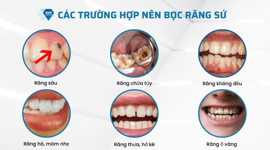 Nên bọc răng sứ khi nào?