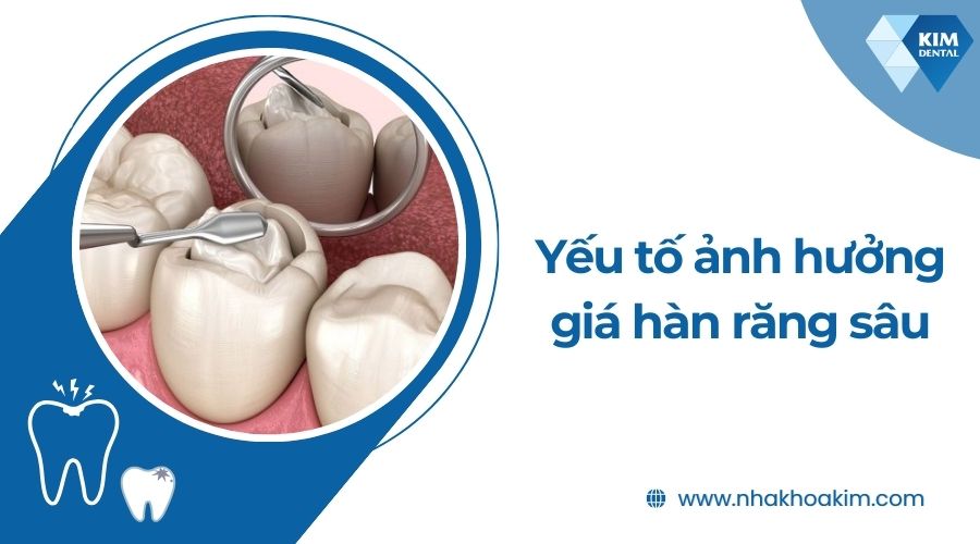 Các yếu tố ảnh hưởng đến giá hàn răng sâu