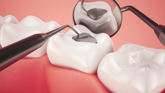 Trám răng thẩm mỹ có đau không? I Chuyên gia giải đáp