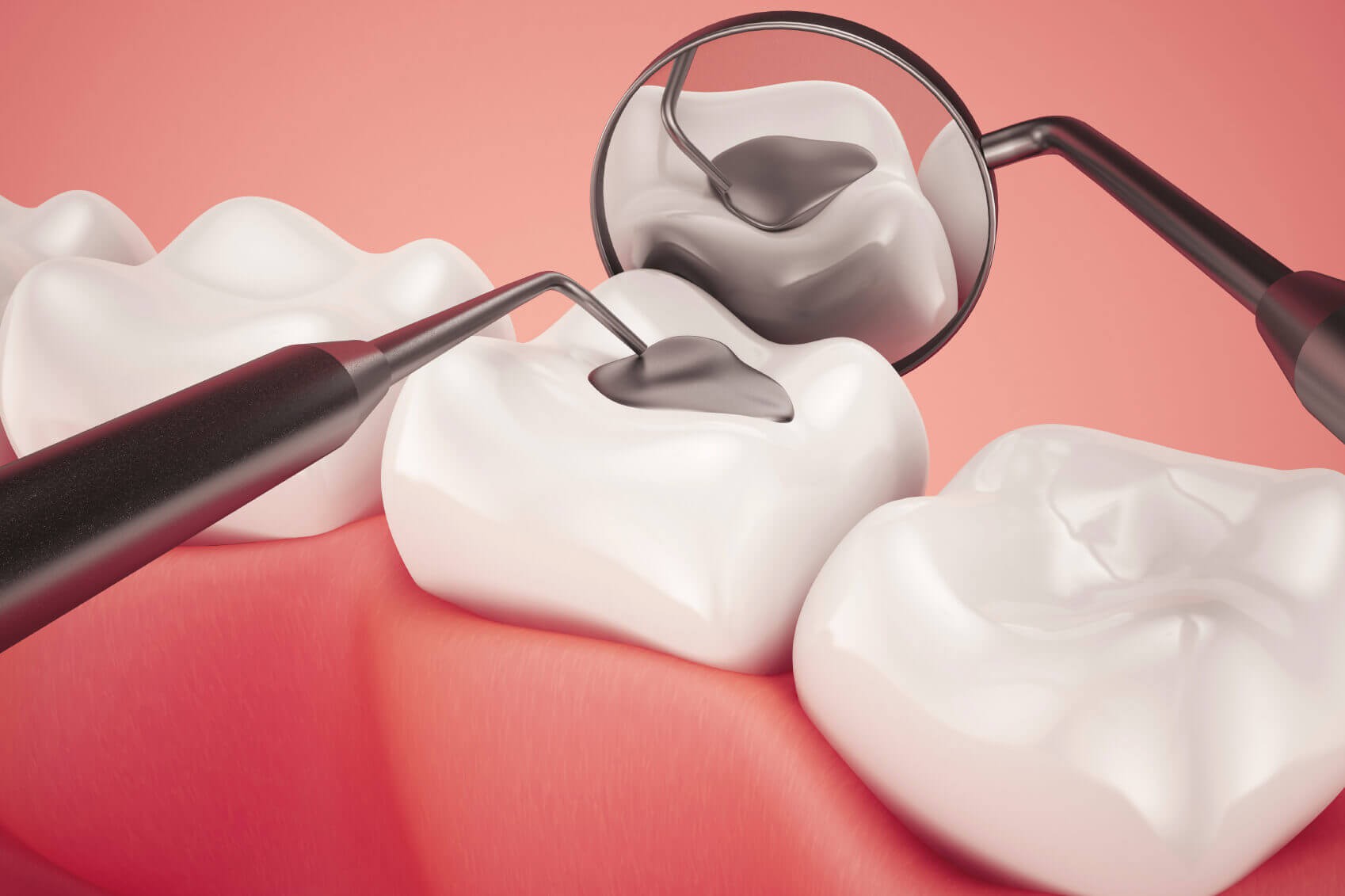 Trám răng thẩm mỹ có đau không? I Chuyên gia giải đáp
