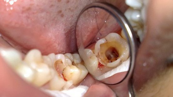 Răng hàm bị sâu – Phương pháp điều trị nhanh chóng