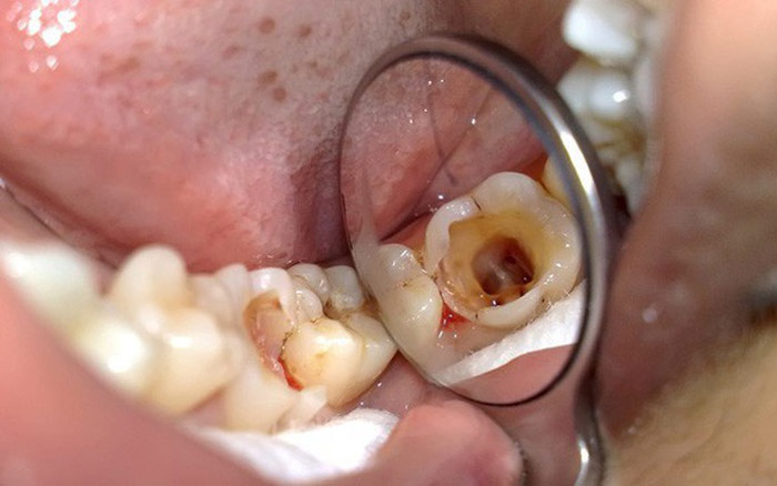 Răng hàm bị sâu - Phương pháp điều trị nhanh chóng