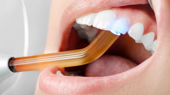 Trám răng thẩm mỹ ở đâu tốt nhất? Tham khảo ý kiến chuyên gia