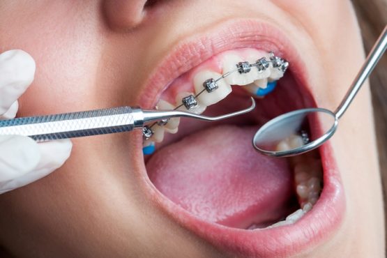Niềng răng nhanh và hiệu quả tại Nha Khoa KIM