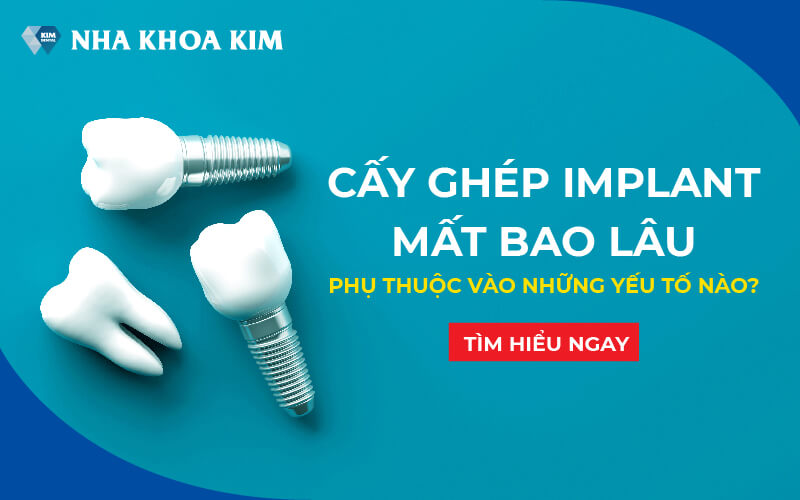 Có bất kỳ quy trình giai đoạn nào khác trước hoặc sau khi trồng răng implant hay không?
