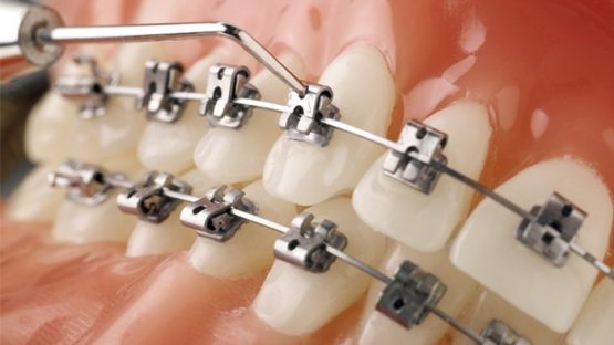 Tác dụng của niềng răng, các loại khí cụ niềng răng