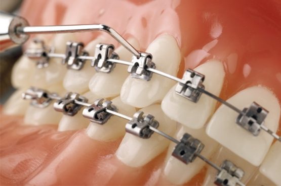 Tác dụng của niềng răng, các loại khí cụ niềng răng