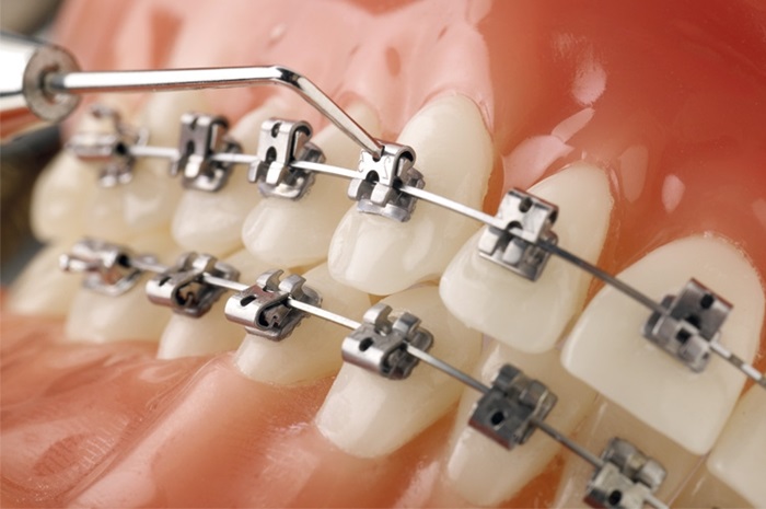 Tại sao hệ thống mắc cài là một dụng cụ không thể thiếu trong niềng răng?