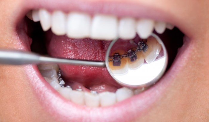 Niềng răng mắc cài mặt trong mang tính thẩm mỹ cao, tuy nhiên cũng có nhiều hạn chế