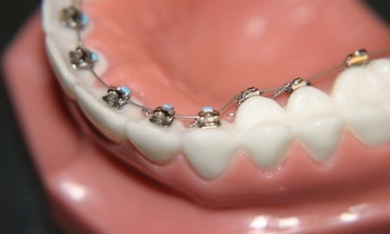 Niềng răng mắc cài mặt lưỡi – Phương pháp niềng bí mật