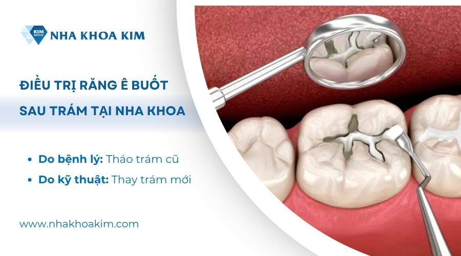 chữa ê răng sau trám tại nha khoa