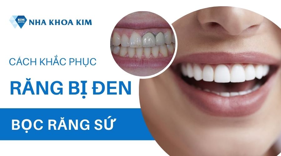 Bọc răng sứ khắc phục tình trạng răng sứ bị đen