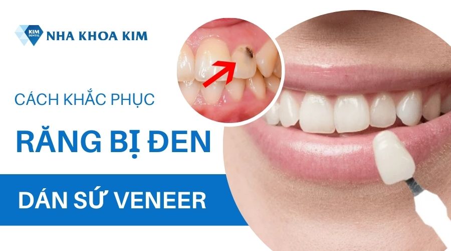 Cách khắc phục tình trạng răng bị xỉ màu đen