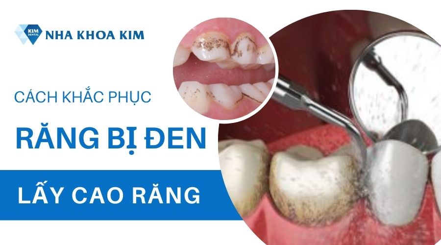 Răng bị mảng bám đen phải làm sao