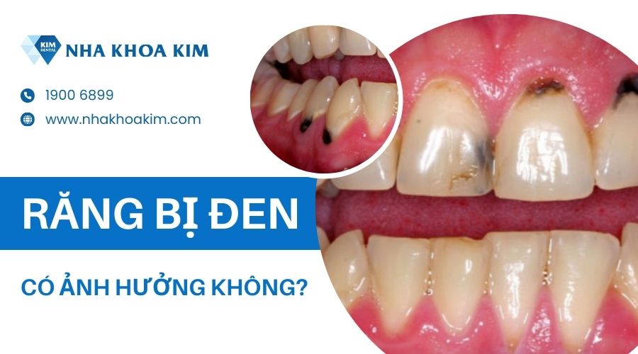 Răng đen có ảnh hưởng gì không?