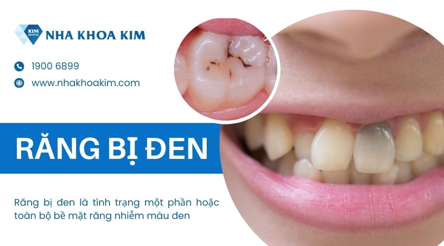 Chân răng bị đen là gì?