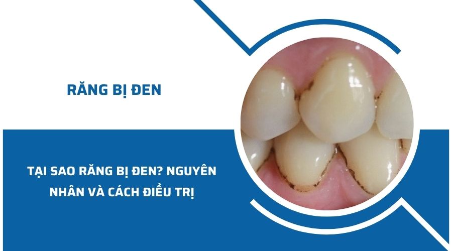 Tại sao chân răng bị đen? Nguyên nhân và cách điều trị