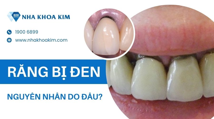 Tại sao răng bị xỉn đen?