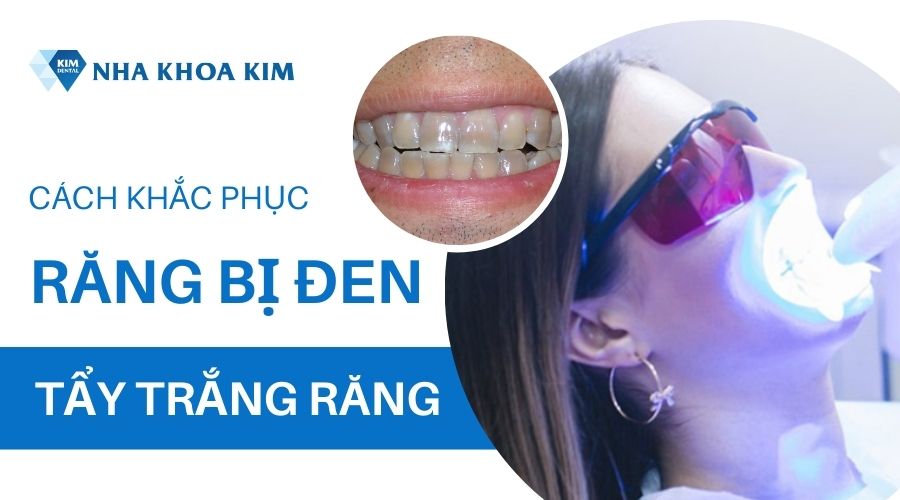 Cách tẩy mảng bám đen trên răng hiệu quả