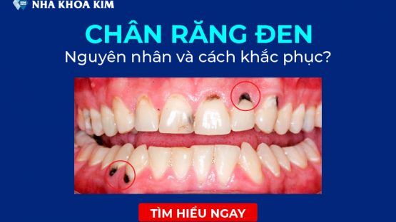 Chân răng bị đen – Nguyên nhân do đâu, làm sao loại bỏ vết đen hiệu quả?