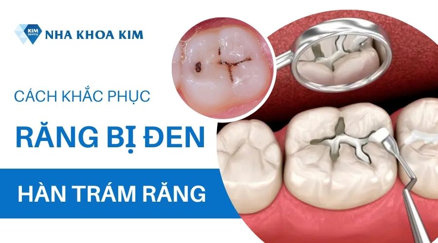 Răng có vết đen ở kẽ phải làm sao