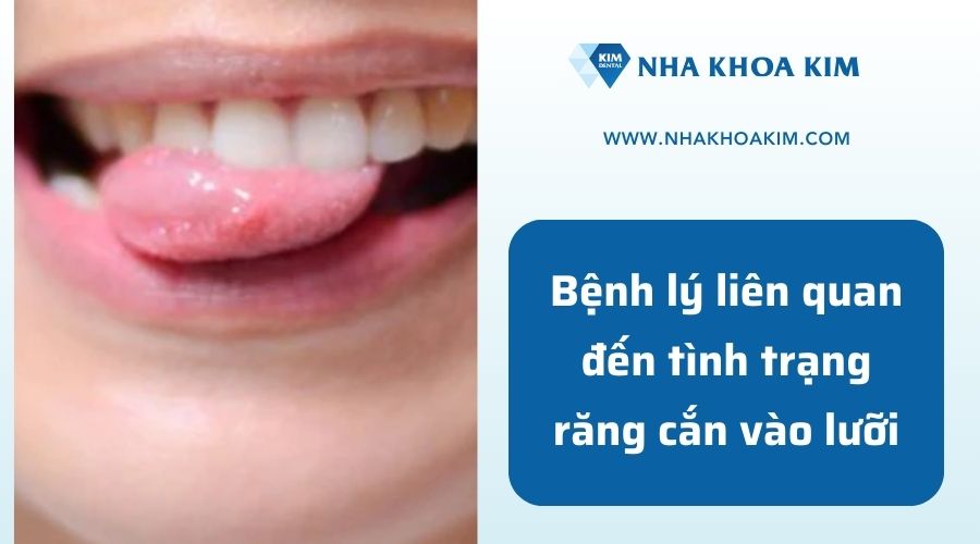 Các bệnh lý liên quan đến cắn vào lưỡi khi ăn 