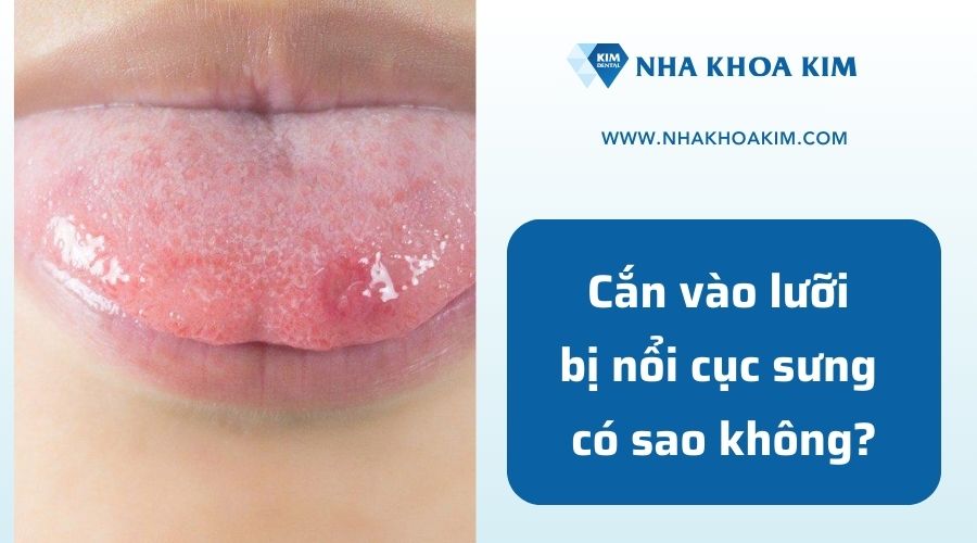 cắn vào lưỡi bị sưng cục có sao không?