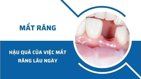 Hậu quả của việc mất răng lâu ngày nguy hiểm như thế nào?