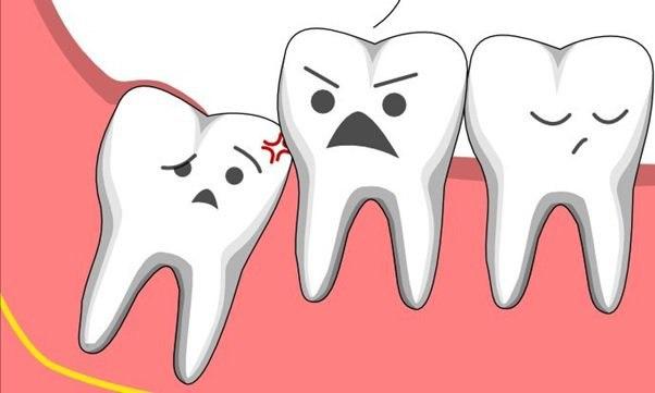Cần ghi nhớ các lưu ý sau khi nhổ răng số 8 để đảm bảo sức khỏe