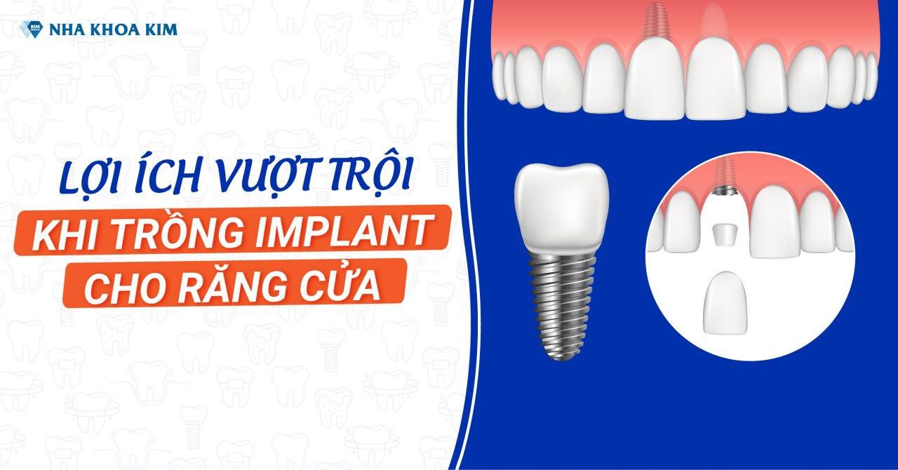 Lợi Ích Vượt Trội Khi Trồng Implant Cho Răng Cửa Lợi Ích Vượt Trội Khi Trồng Implant Cho Răng Cửa