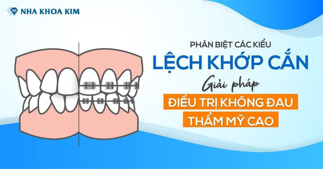 Phân Biệt Các Kiểu Lệch Khớp Cắn Và Giải Pháp Điều Trị Không Đau, Thẩm Mỹ Cao Phân Biệt Các Kiểu Lệch Khớp Cắn Và Giải Pháp Điều Trị Không Đau, Thẩm Mỹ Cao