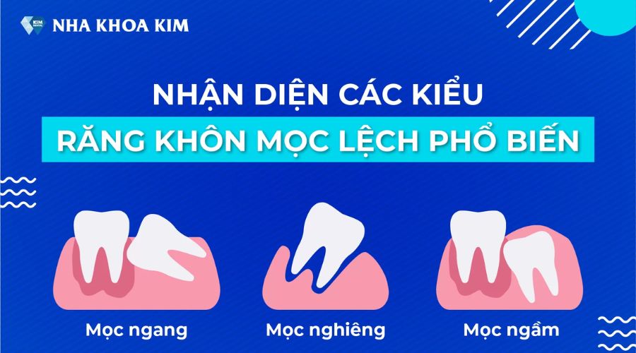 Các kiểu răng khôn mọc lệch