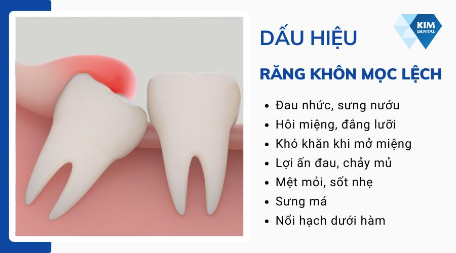 Dấu hiệu răng khôn mọc lệch